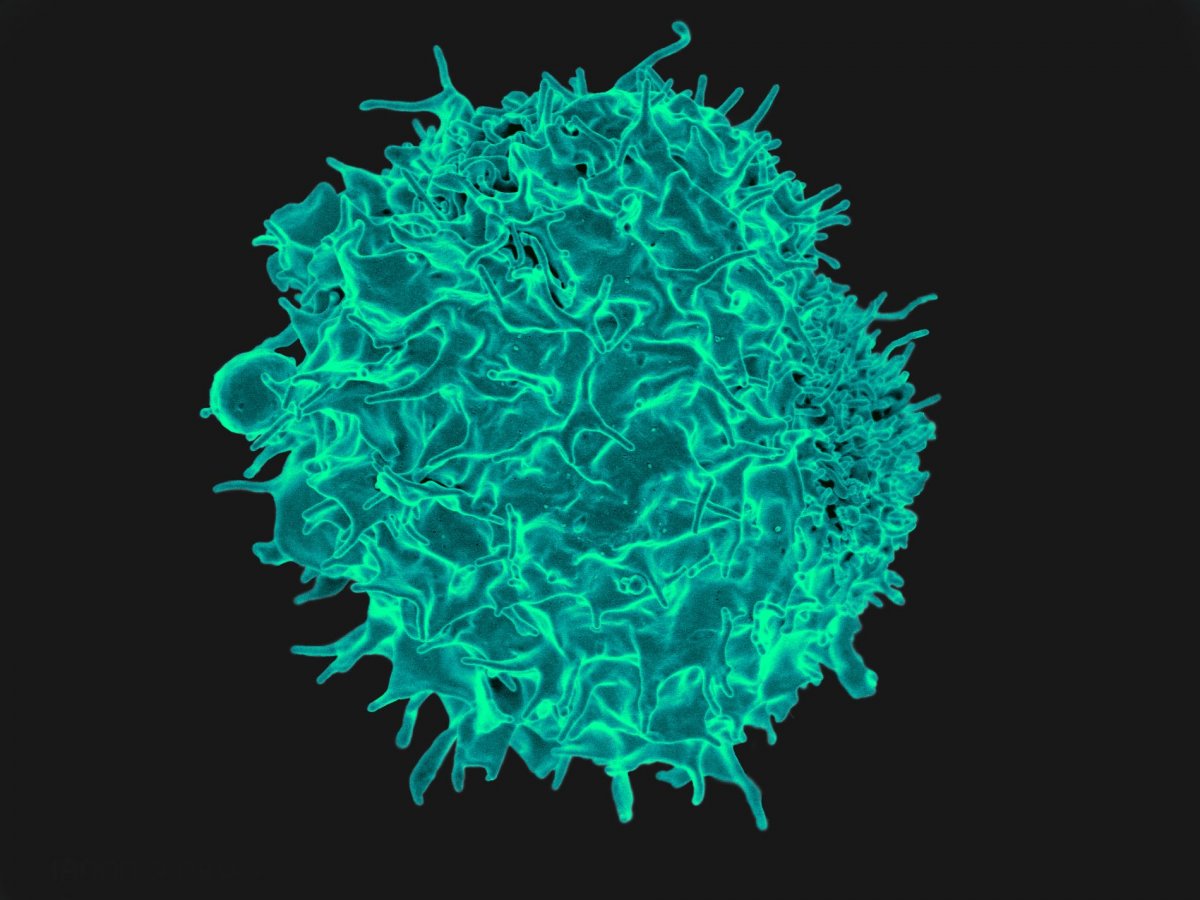 靶向GPC3的CAR-T疗法联合药物获得了完全缓解和长期生存，肝细胞癌患者的福音