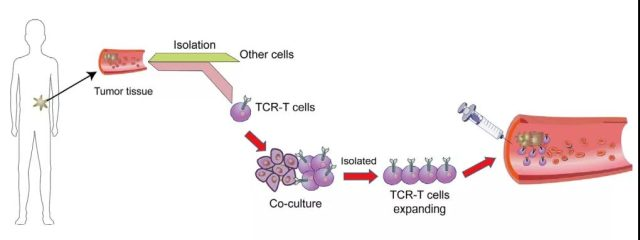肿瘤减少74.5%！TCR-T细胞疗法在肝癌中大展身手