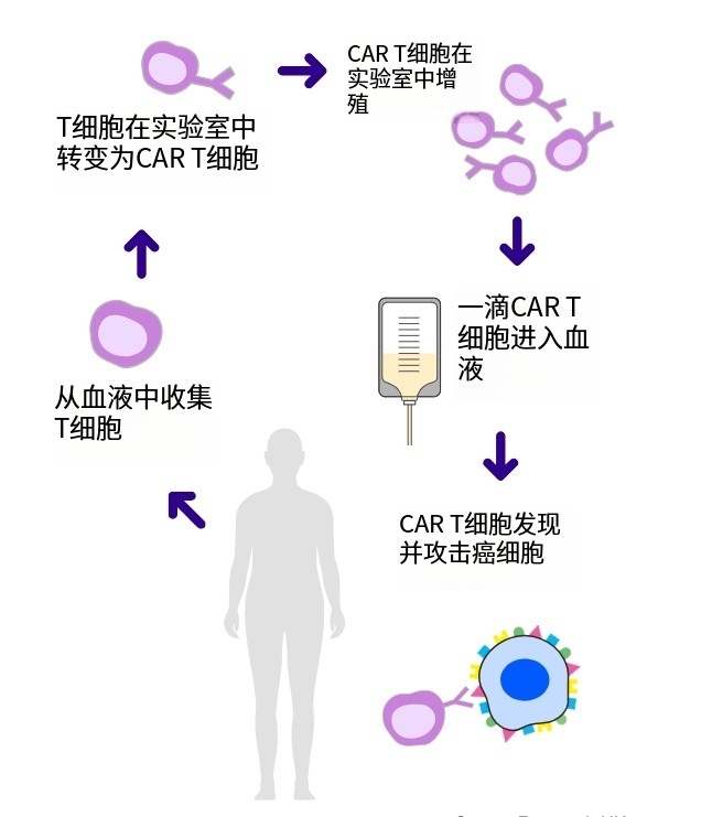 肿瘤完全消失！CAR-T细胞疗法研究进展：白血病、胃癌患者获益