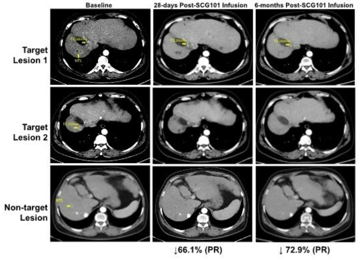 肿瘤减少74.5%！TCR-T细胞疗法SCG101打击肝细胞癌，生存期超1.5年！