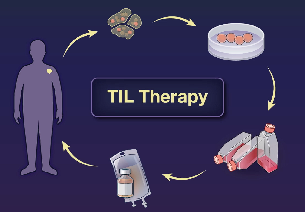 TIL细胞疗法重创消化系统肿瘤，肝癌、肠癌、胰腺癌患者获益