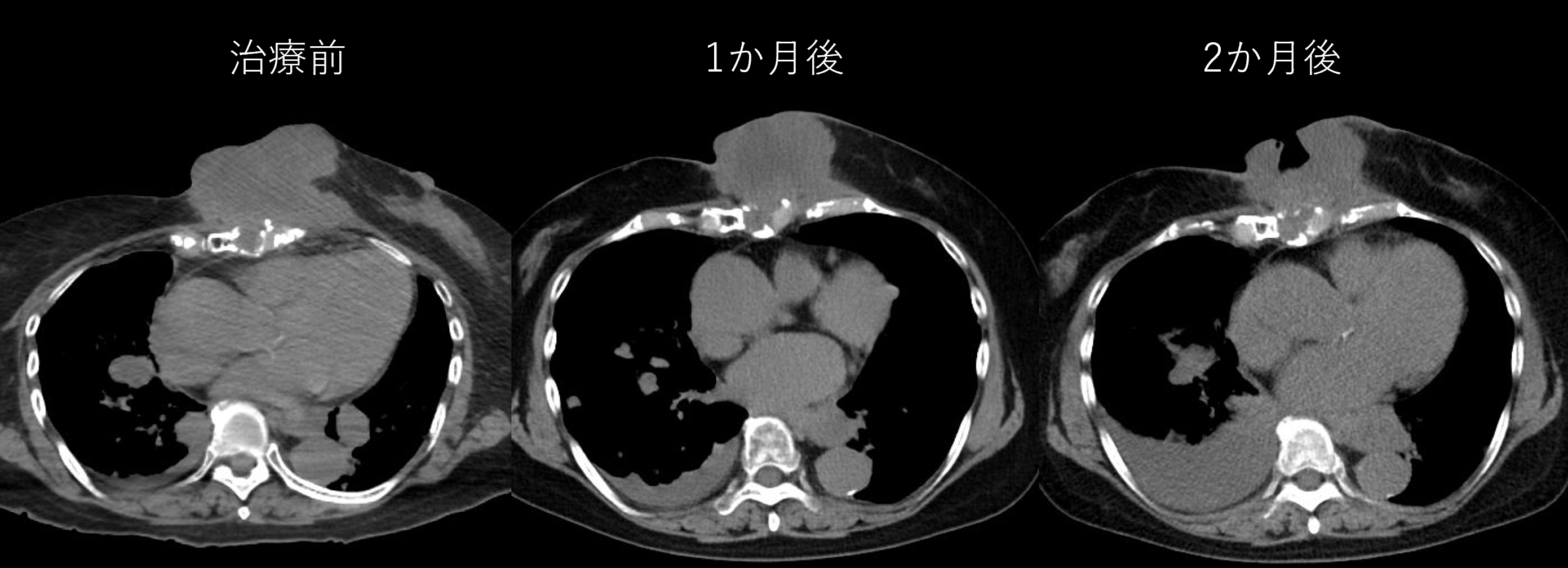 抗癌黑科技-硼中子俘获治疗横扫乳腺癌、肉瘤、黑色素瘤、头颈癌、脑胶质瘤