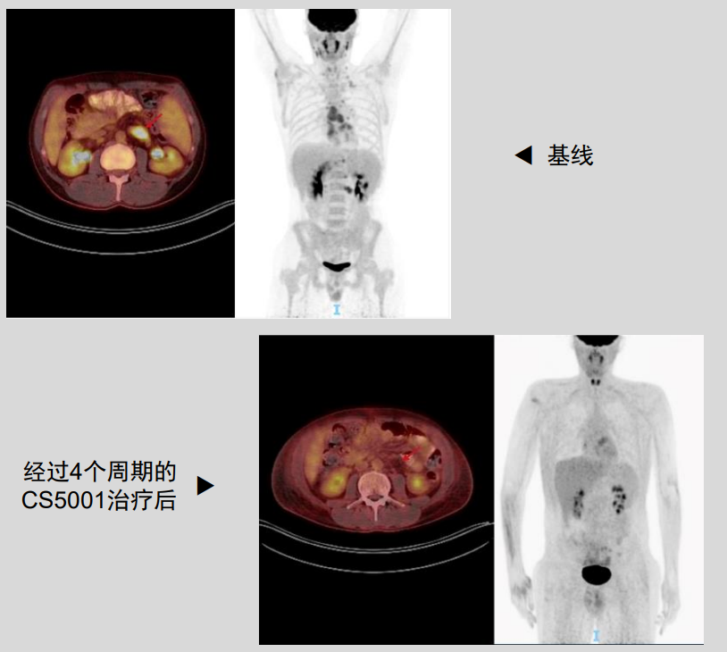 CS5001针对晚期淋巴瘤的最新临床数据亮相ASH