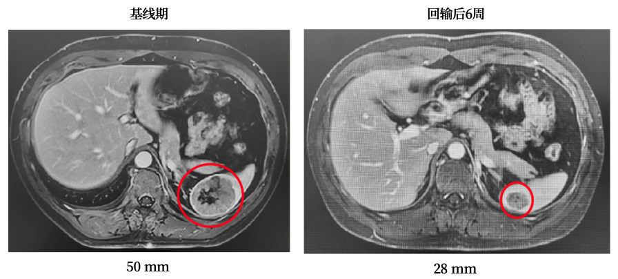 ROS1融合阳性非小细胞肺癌患者经GC101 TIL治疗后肿瘤缩小33%