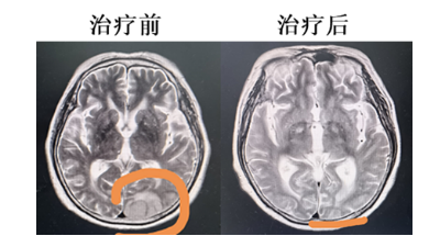 乘典生物的PD-1Ab21-CAR-T治疗晚期B细胞恶性肿瘤取得良好疗效