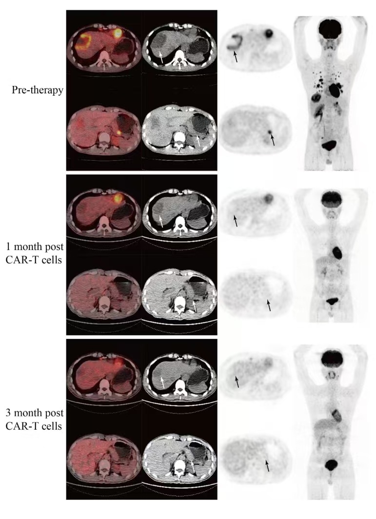 抗癌战场的新希望！CAR-T疗法在结直肠癌、肉瘤、肝癌中大放异彩