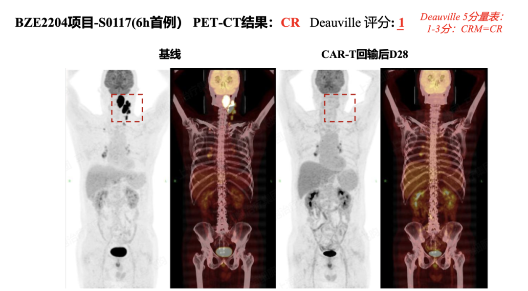 首例治疗难治复发弥漫大B细胞淋巴瘤患者1个月便获得完全缓解