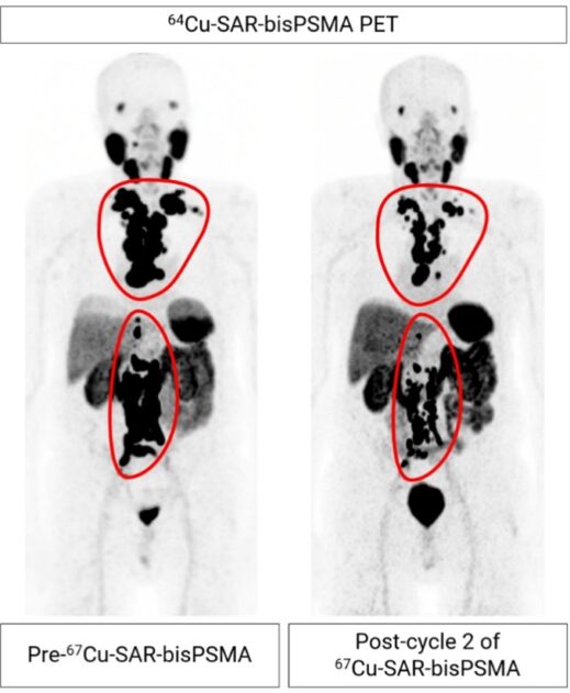 美国FDA授予67Cu-SAR-bisPSMA 快速通道指定